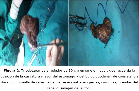 Síndrome de Rapunzel: Diagnóstico y Tratamiento en Madrid 2 sindrome de rapunzel diagnostico y tratamiento en madrid
