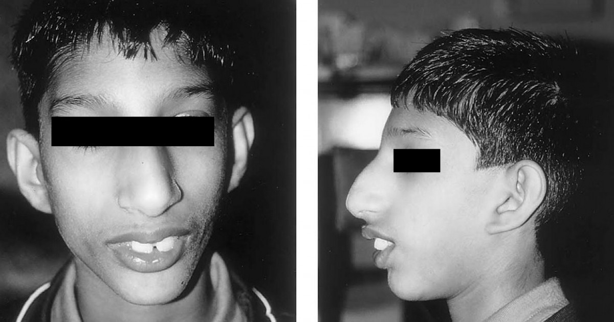 SÍNDROME DE SECKEL: Causas, SÍNTOMAS y Tratamiento EFECTIVO 31 sindrome de seckel causas sintomas y tratamiento efectivo