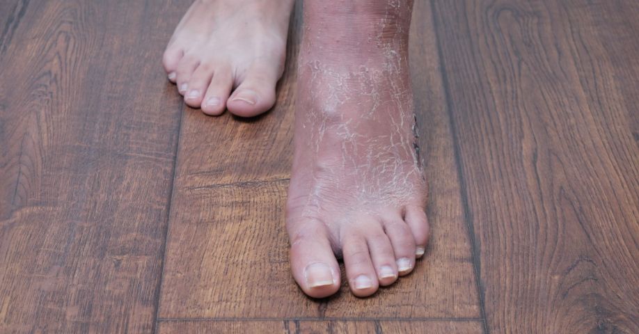SÍNDROME DE SUDECK tiene CURA DESCUBRE el MANEJO EFECTIVO 2 sindrome de sudeck tiene cura descubre el manejo efectivo