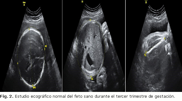 Síndrome de Wolf-Hirschhorn: Diagnóstico y Tratamiento Clave 4 sindrome de wolf hirschhorn diagnostico y tratamiento clave