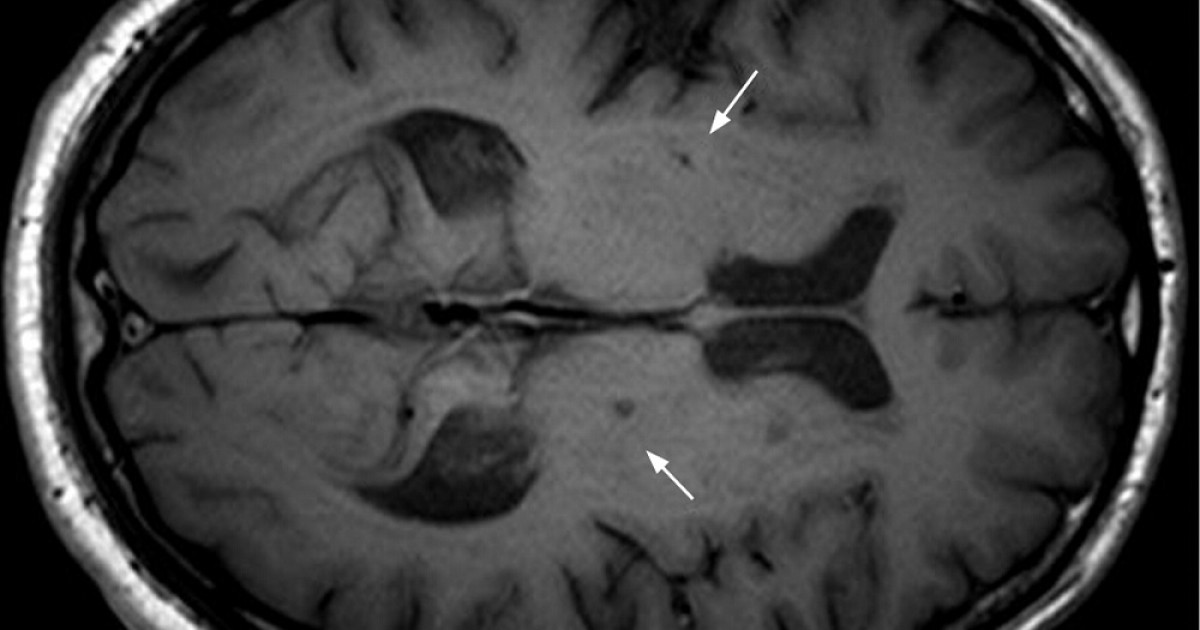 SÍNDROME LACUNAR: Causas, SÍNTOMAS y Tratamiento Efectivo 2 sindrome lacunar causas sintomas y tratamiento efectivo