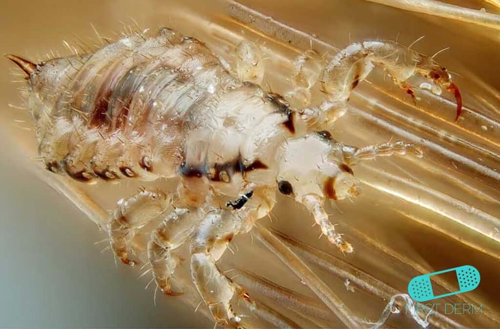 Soñar con Piojos: ¡Descubre su Impactante Significado! 2 sonar con piojos descubre su impactante significado
