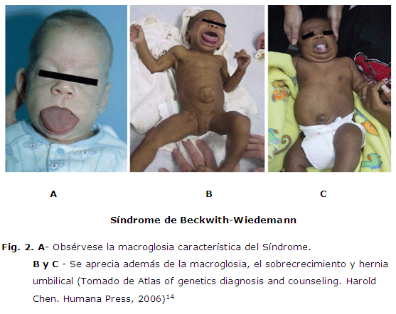 Sotos Síndrome: Diagnóstico y Tratamiento Efectivo en Madrid 2 sotos sindrome diagnostico y tratamiento efectivo en madrid