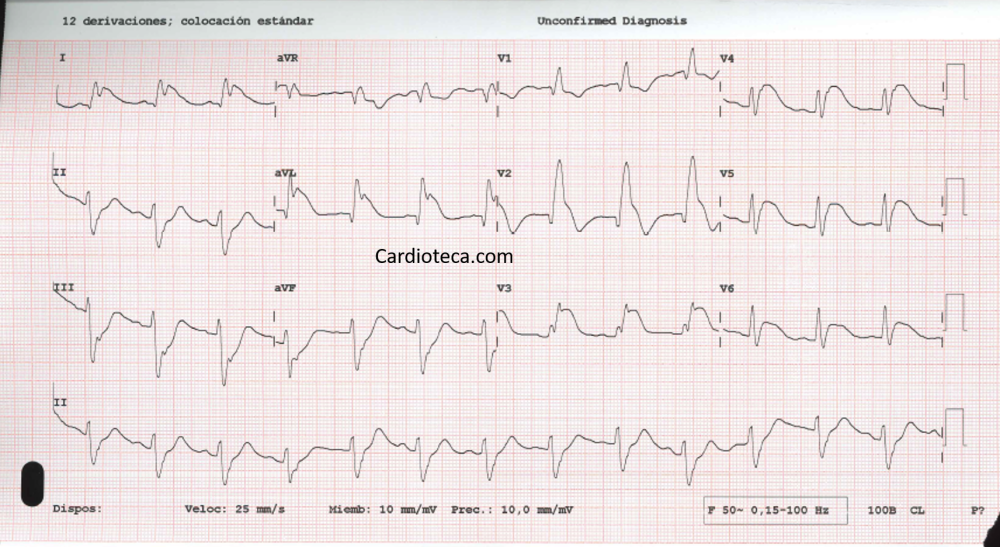Tachycardia en el EMBARAZO: Causas y SOLUCIONES Efectivas 2 tachycardia en el embarazo causas y soluciones efectivas