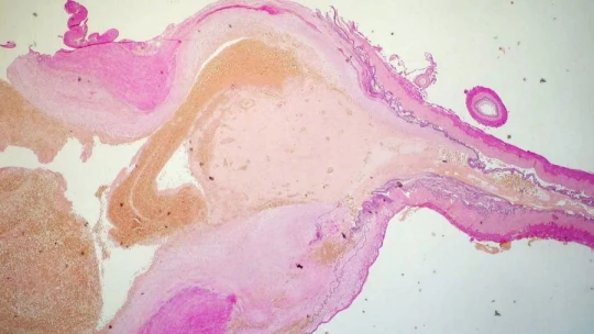 Tipos de ANEURISMA: Síntomas y CARACTERÍSTICAS Esenciales 2 tipos de aneurisma sintomas y caracteristicas esenciales