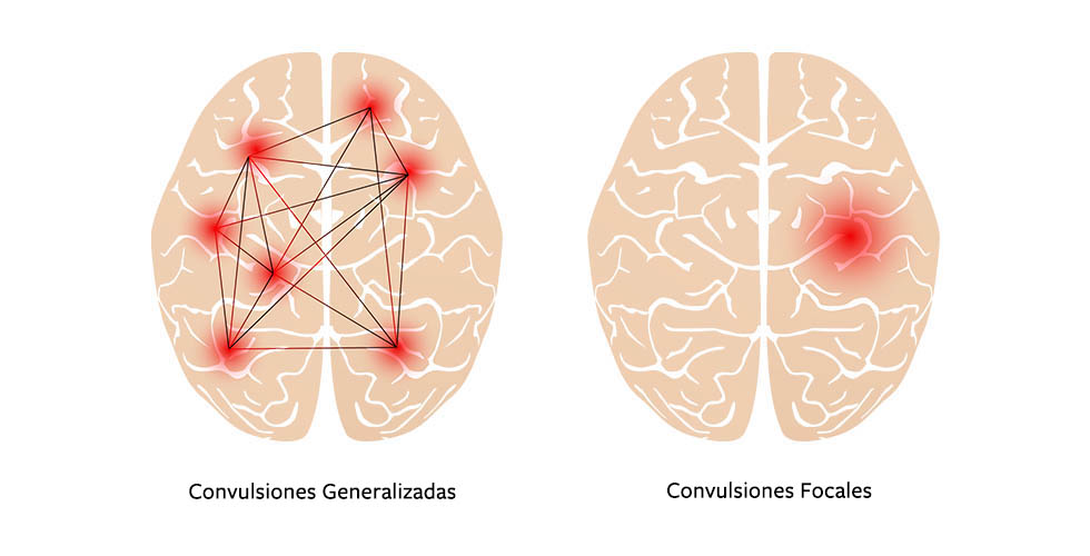 Tipos de CONVULSIONES: Causas y SÍNTOMAS que Debes Conocer 2 tipos de convulsiones causas y sintomas que debes conocer