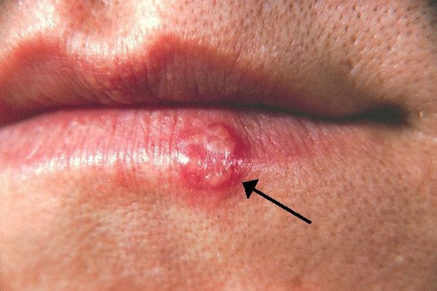 tipos de herpes caracteristicas y enfermedades asociadas