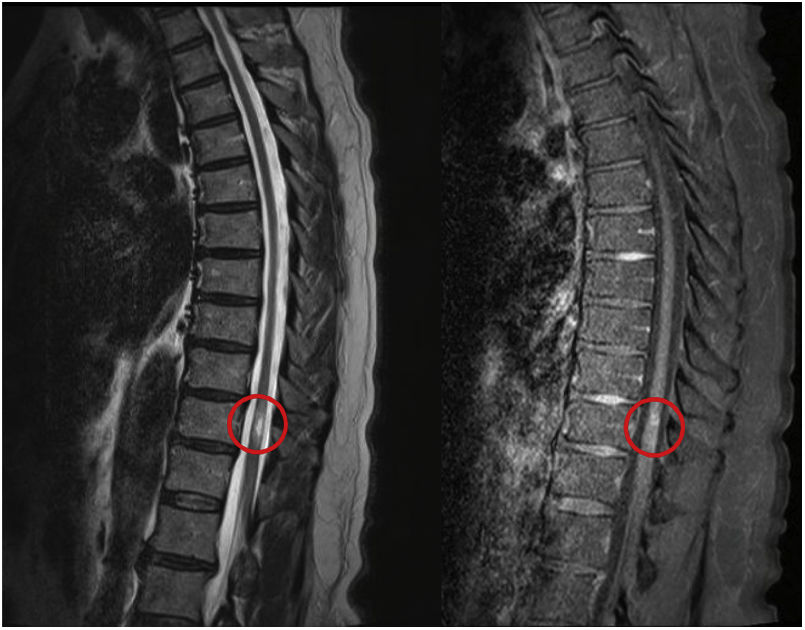 tratamiento efectivo de transverse myelitis en madrid