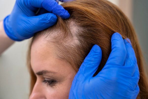Tricotilomanía: Tratamientos Efectivos que No Conocías 2 tricotilomania tratamientos efectivos que no conocias