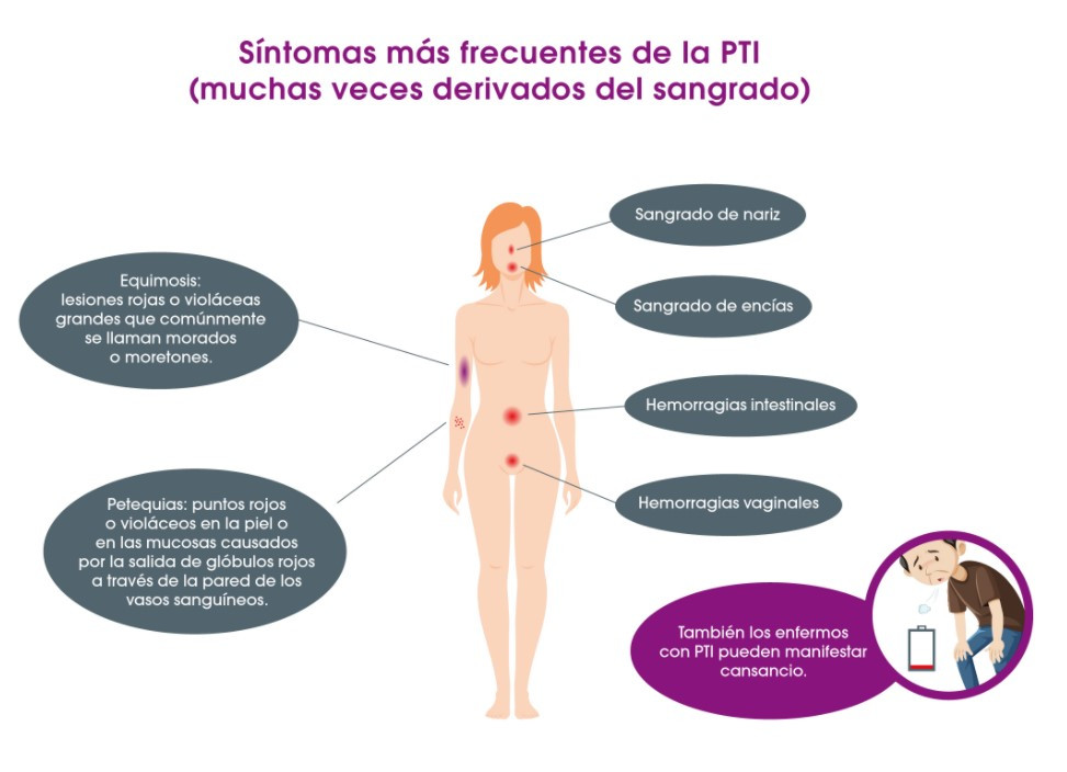 TROMBOCITOPENIA: Síntomas, Causas y Tratamiento en Madrid 2 trombocitopenia sintomas causas y tratamiento en madrid