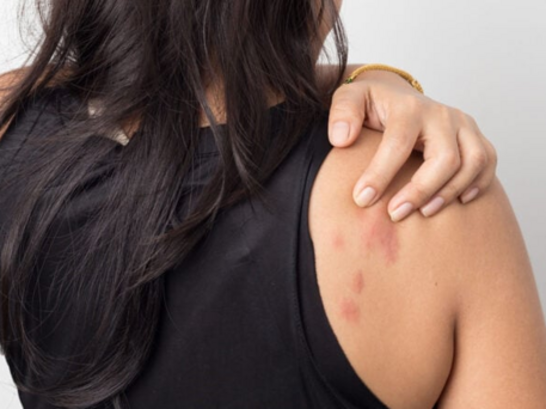 urticaria por estres soluciones para tu piel y emociones