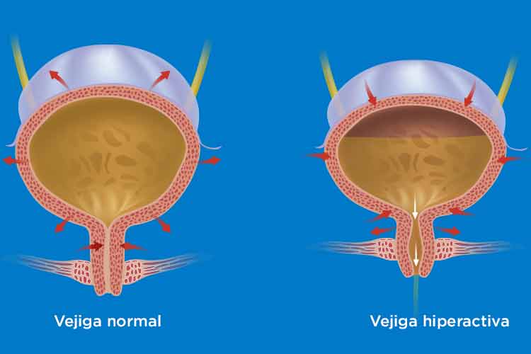 vejiga hiperactiva por ansiedad causas y soluciones